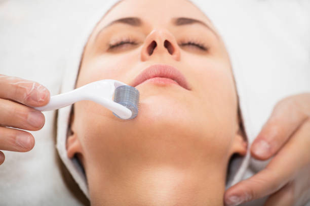 Face microneedling treatment with a meso roller.