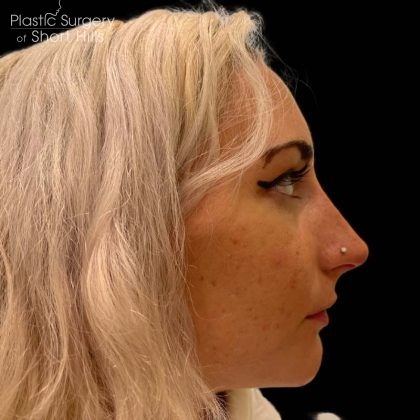 Liquid Rhinoplasty(Non-Surgical) Before & After Patient #16244