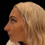 Liquid Rhinoplasty(Non-Surgical) Before & After Patient #16244