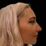 Liquid Rhinoplasty(Non-Surgical) Before & After Patient #16244