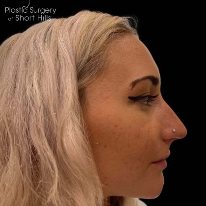 Liquid Rhinoplasty(Non-Surgical) Before & After Patient #16244