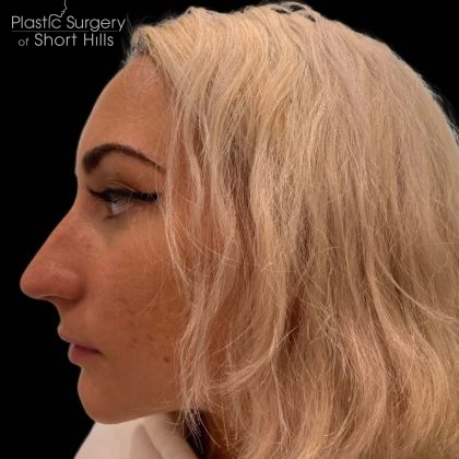 Liquid Rhinoplasty(Non-Surgical) Before & After Patient #16244