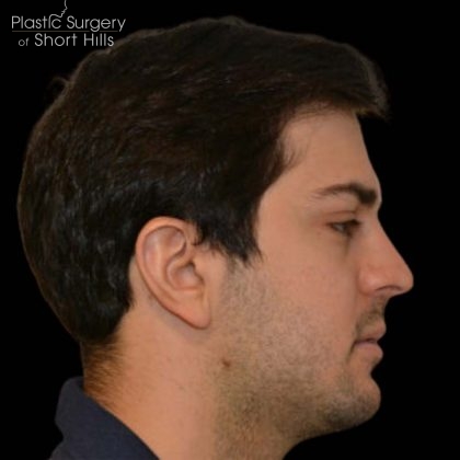Facial Implants Before & After Patient #16229