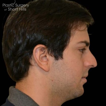 Facial Implants Before & After Patient #16229