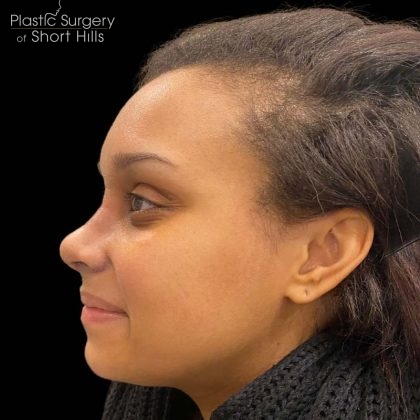 Rhinoplasty Before & After Patient #16209