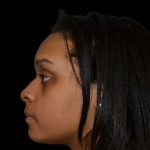 Rhinoplasty Before & After Patient #16209