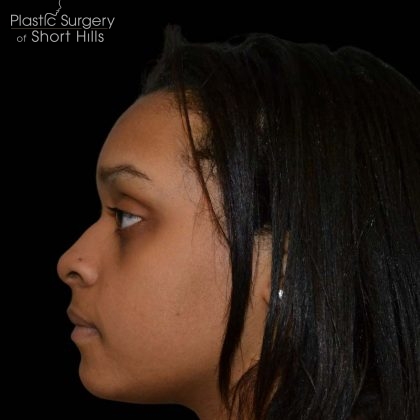 Rhinoplasty Before & After Patient #16209