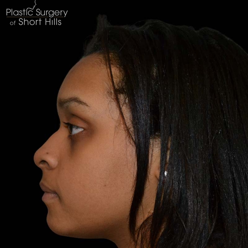 Rhinoplasty Before & After Patient #16209