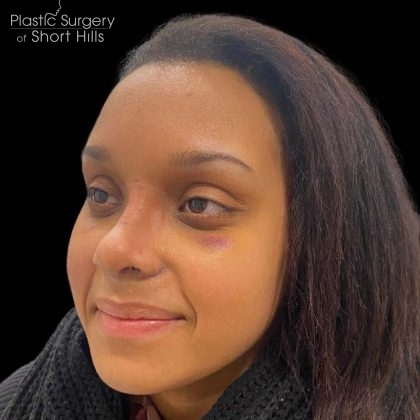 Rhinoplasty Before & After Patient #16209