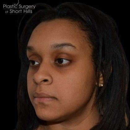 Rhinoplasty Before & After Patient #16209