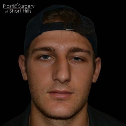 Rhinoplasty Before & After Patient #16203