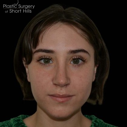 Rhinoplasty Before & After Patient #16208