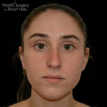 Rhinoplasty Before & After Patient #16208