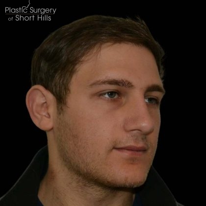 Rhinoplasty Before & After Patient #16203