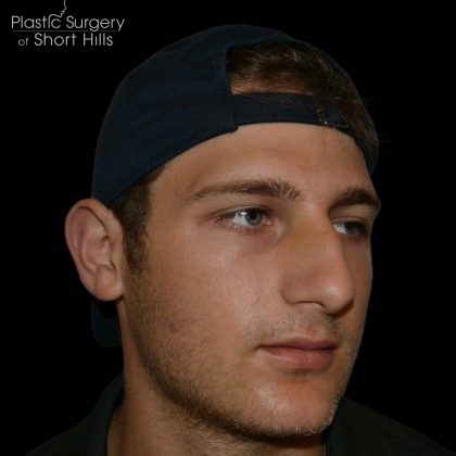 Rhinoplasty Before & After Patient #16203