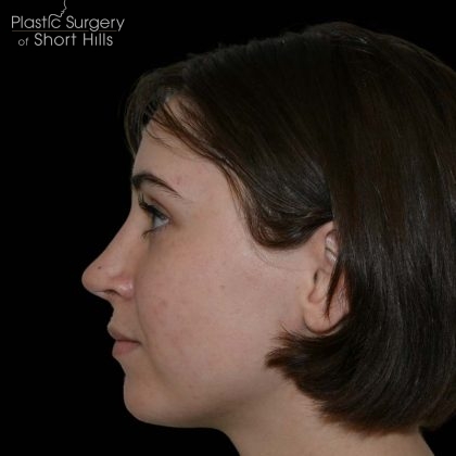 Rhinoplasty Before & After Patient #16208