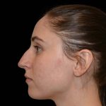 Rhinoplasty Before & After Patient #16208