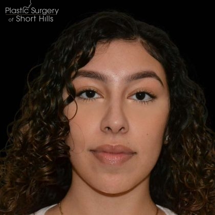 Rhinoplasty Before & After Patient #16201