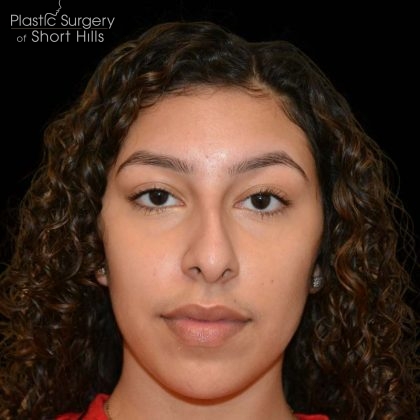 Rhinoplasty Before & After Patient #16201