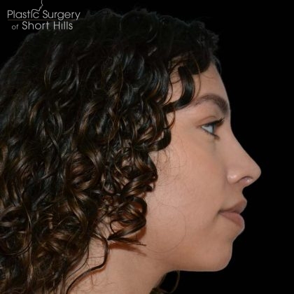 Rhinoplasty Before & After Patient #16201