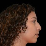 Rhinoplasty Before & After Patient #16201