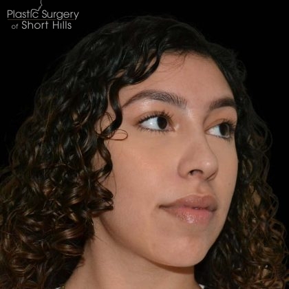 Rhinoplasty Before & After Patient #16201