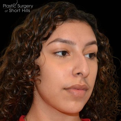 Rhinoplasty Before & After Patient #16201