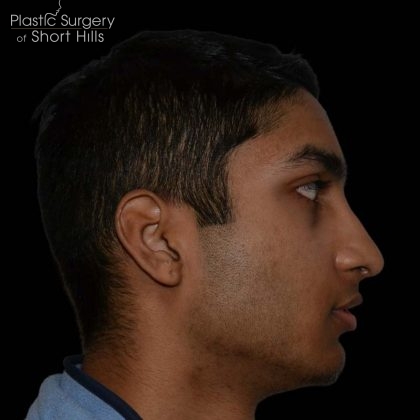 Rhinoplasty Before & After Patient #16199