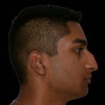 Rhinoplasty Before & After Patient #16199