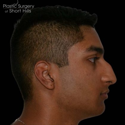 Rhinoplasty Before & After Patient #16199