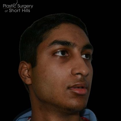 Rhinoplasty Before & After Patient #16199