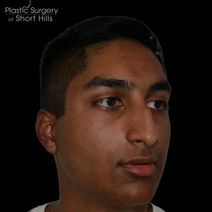 Rhinoplasty Before & After Patient #16199