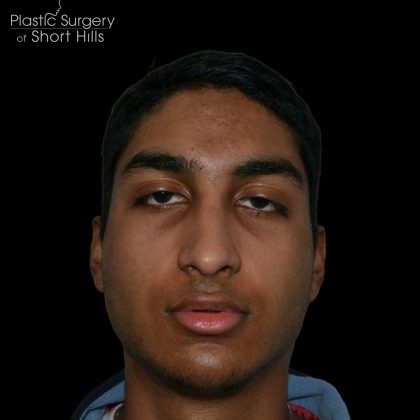 Rhinoplasty Before & After Patient #16199