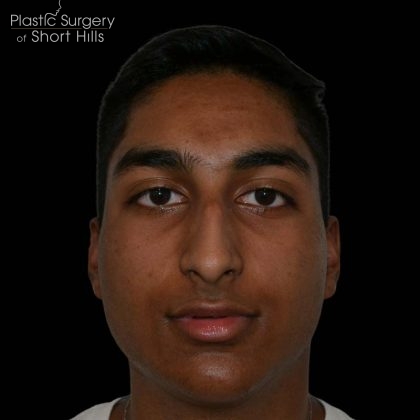 Rhinoplasty Before & After Patient #16199