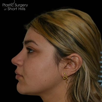 Rhinoplasty Before & After Patient #16198