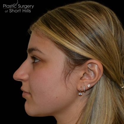 Rhinoplasty Before & After Patient #16198