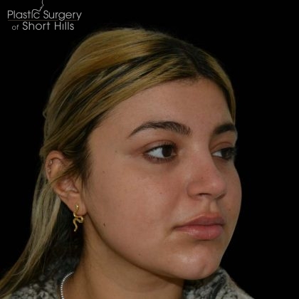 Rhinoplasty Before & After Patient #16198