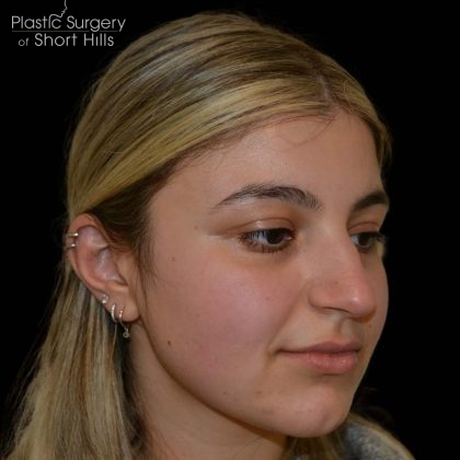 Rhinoplasty Before & After Patient #16198