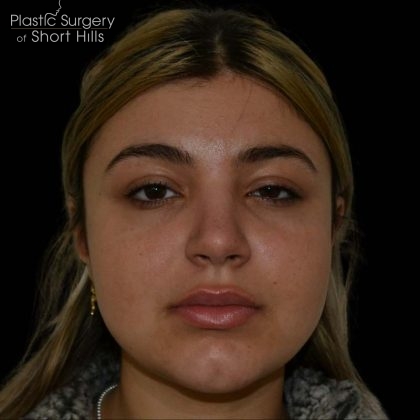 Rhinoplasty Before & After Patient #16198