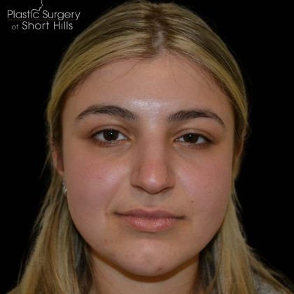 Rhinoplasty Before & After Patient #16198