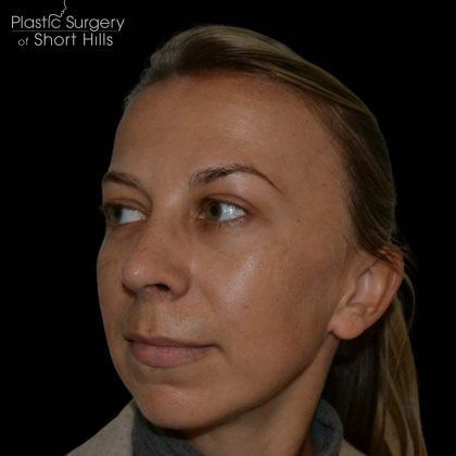 Rhinoplasty Before & After Patient #16197