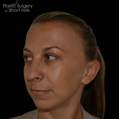 Rhinoplasty Before & After Patient #16197