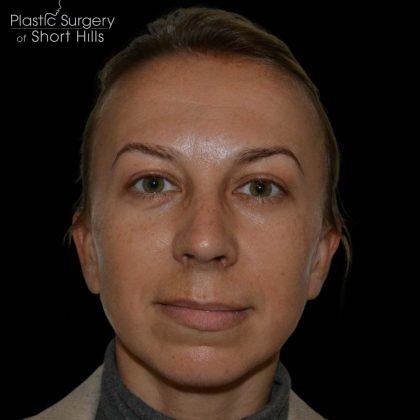 Rhinoplasty Before & After Patient #16197