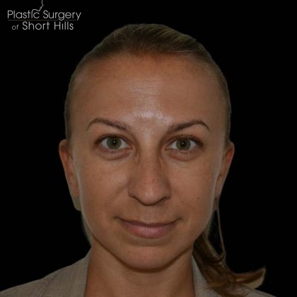 Rhinoplasty Before & After Patient #16197