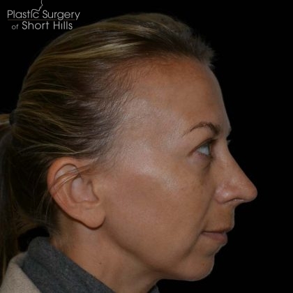 Rhinoplasty Before & After Patient #16197