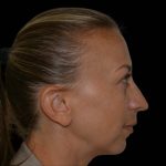 Rhinoplasty Before & After Patient #16197