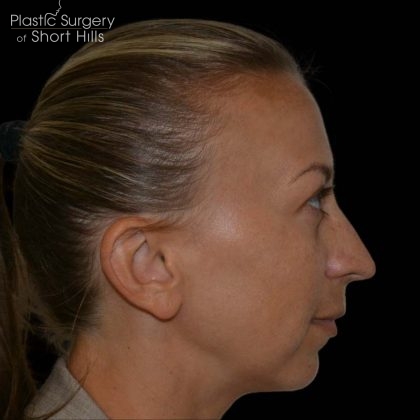 Rhinoplasty Before & After Patient #16197