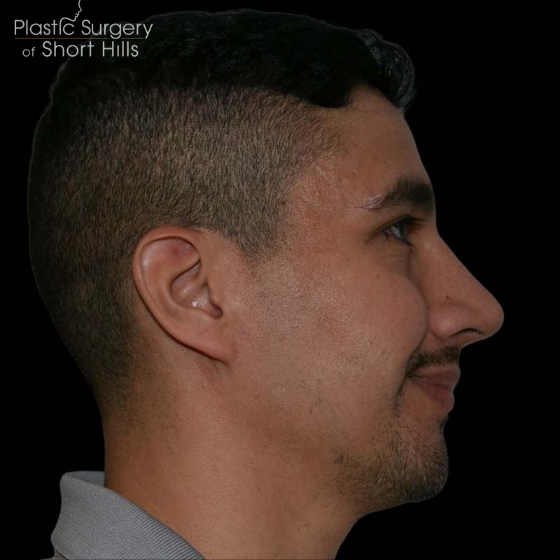 Rhinoplasty Before & After Patient #16196