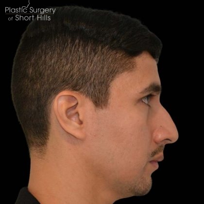 Rhinoplasty Before & After Patient #16196