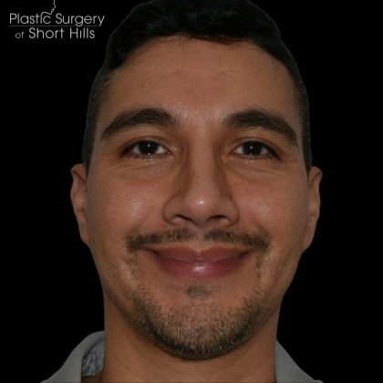 Rhinoplasty Before & After Patient #16196